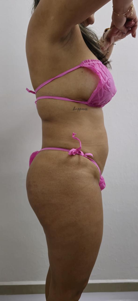 Estado antes del tratamiento corporal en Belle Aesthetic