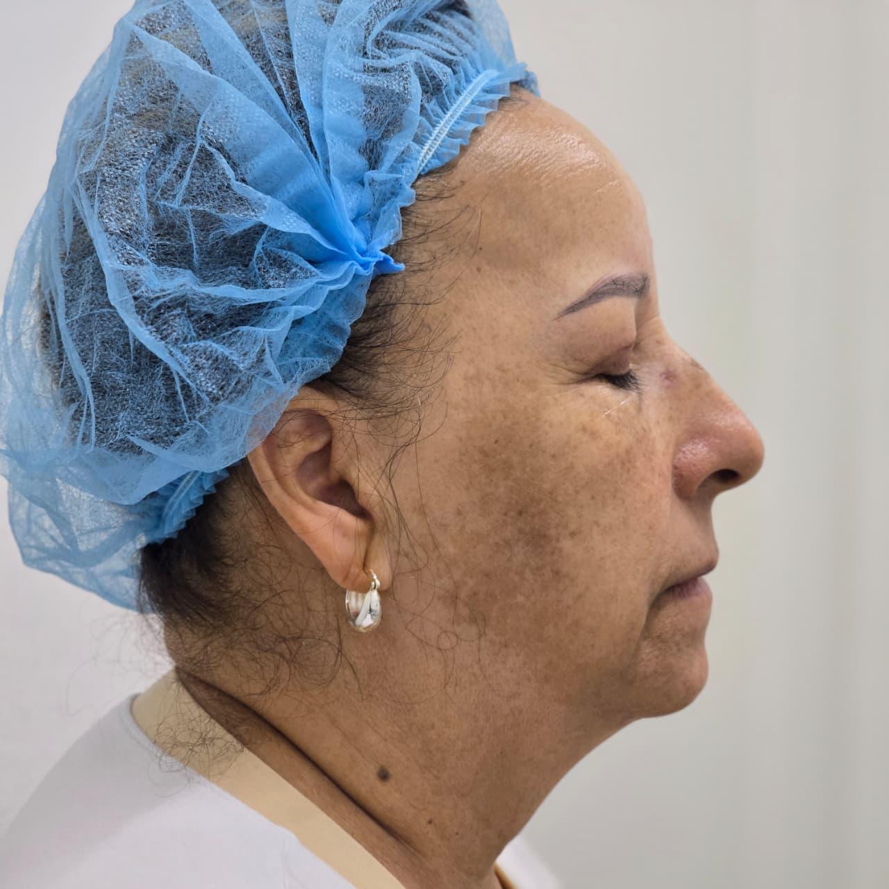 Estado antes del tratamiento facial para manchas