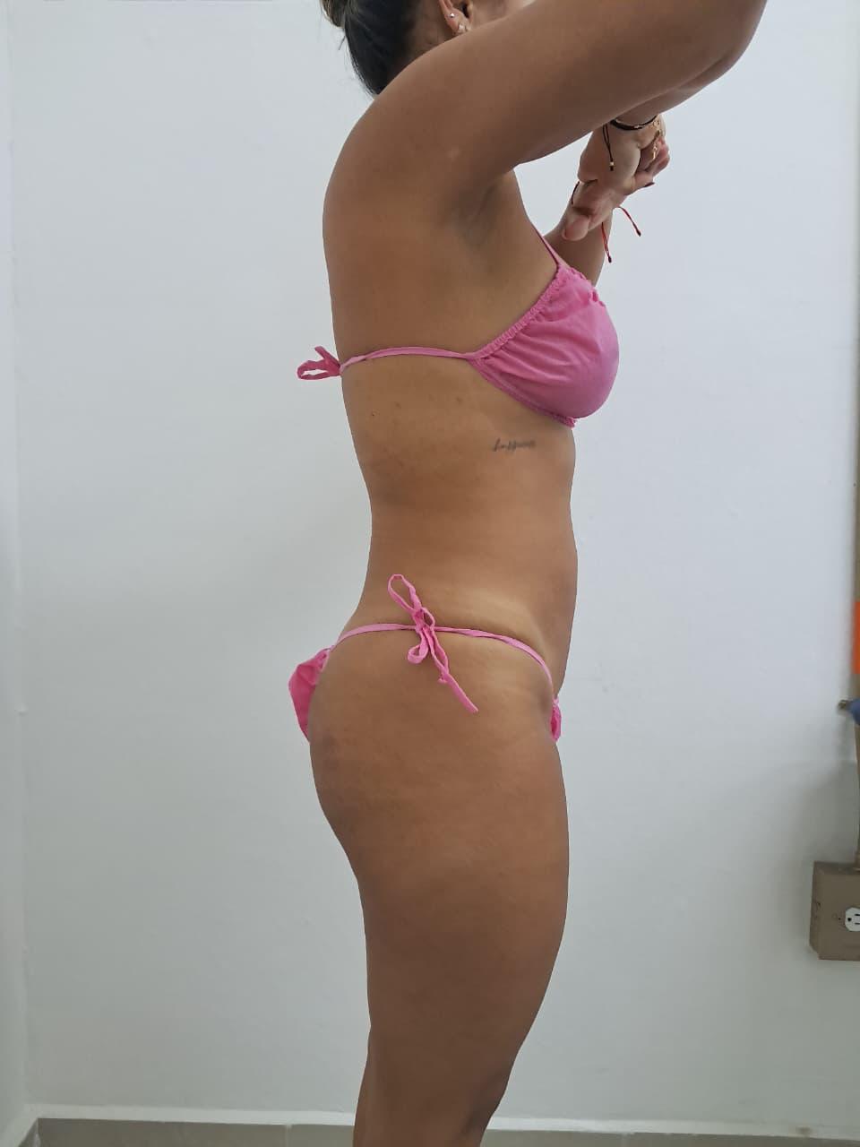 Resultado después del tratamiento corporal reductivo y reafirmante en Medellín